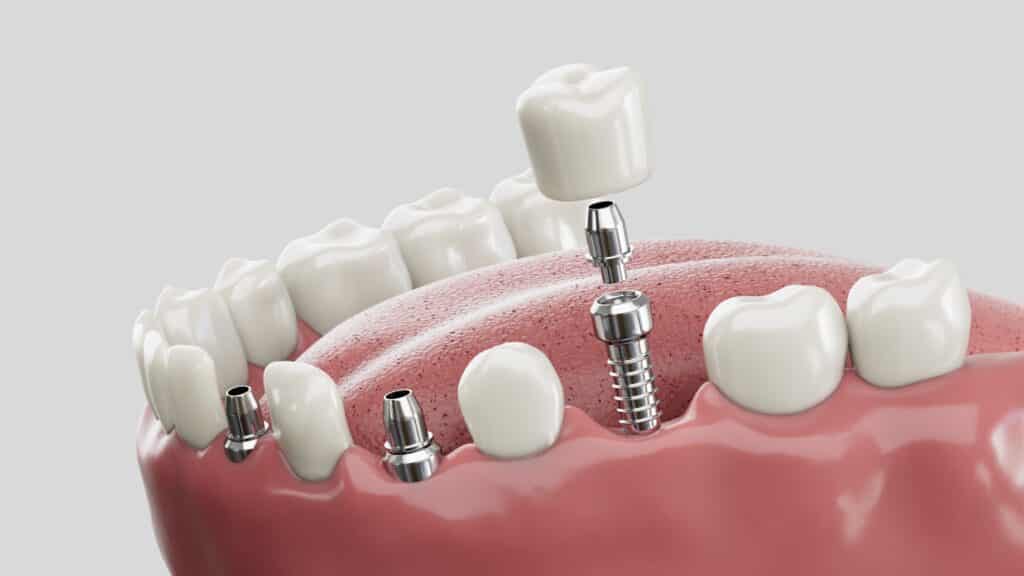 dental implants near me