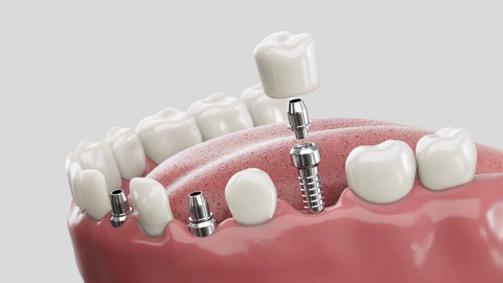 dental implants near me