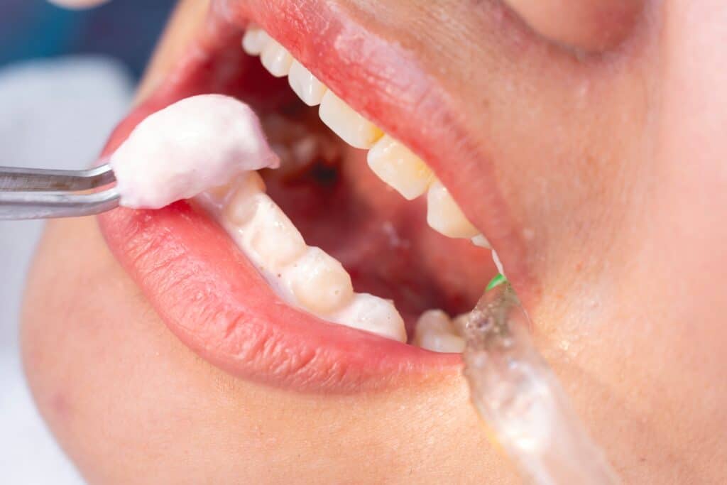 fluoride toothpaste for gum disease